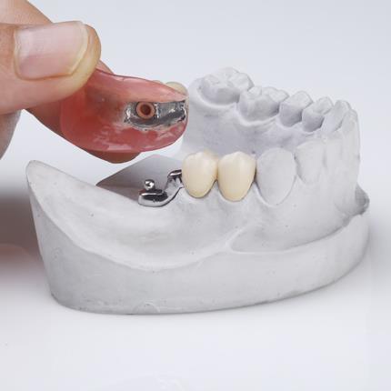 dental precision attachment partial denture for teeth good biocompatibility