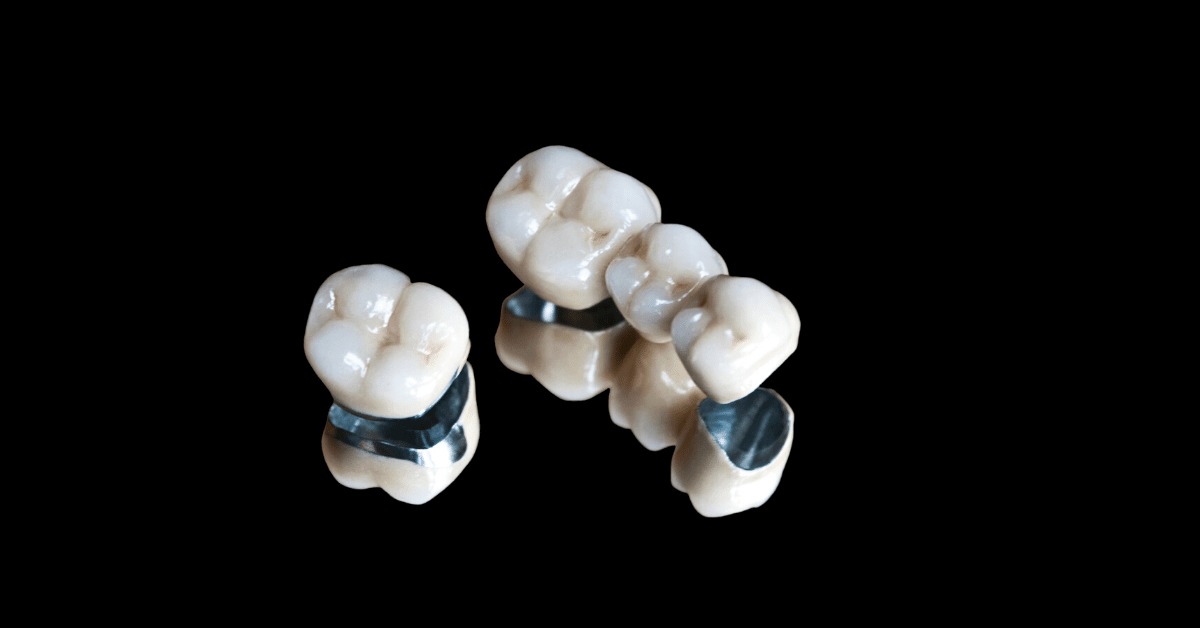 dental crown vs. dental bridge