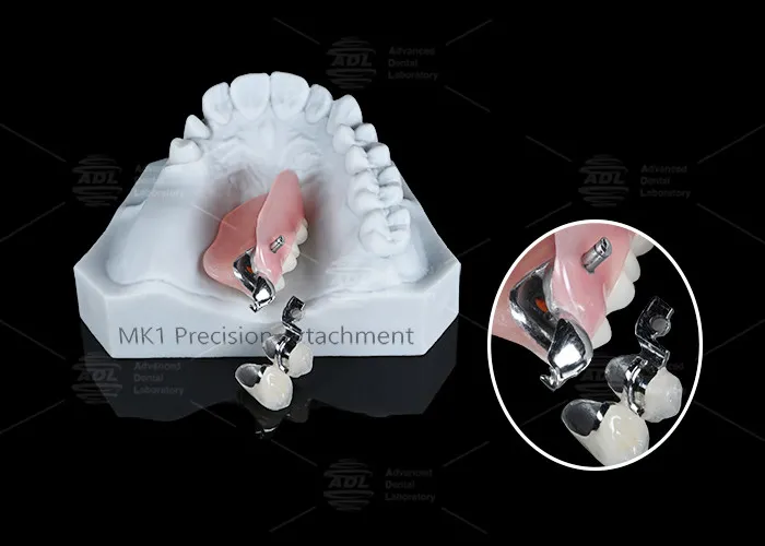 pl176837900 mk1 attachment dental prosthesis silver partial denture precision attachments