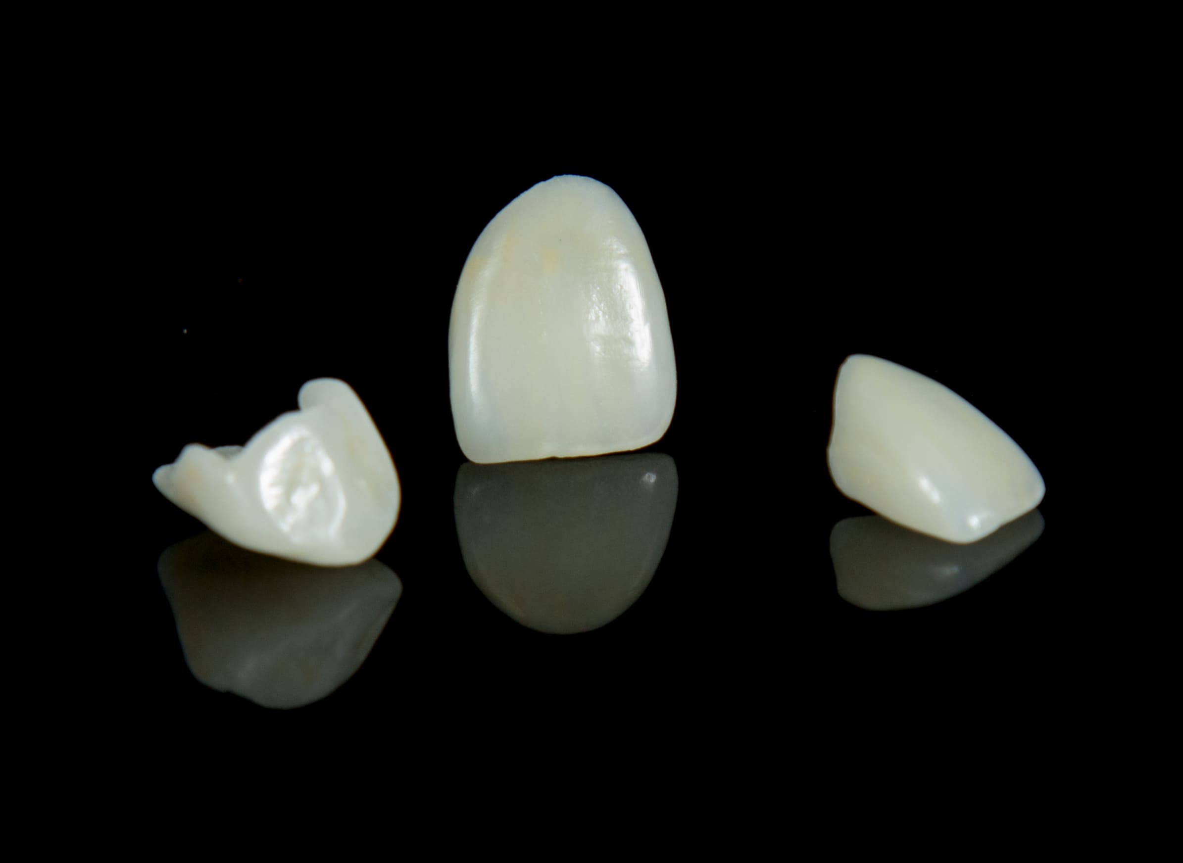 emax veneers min